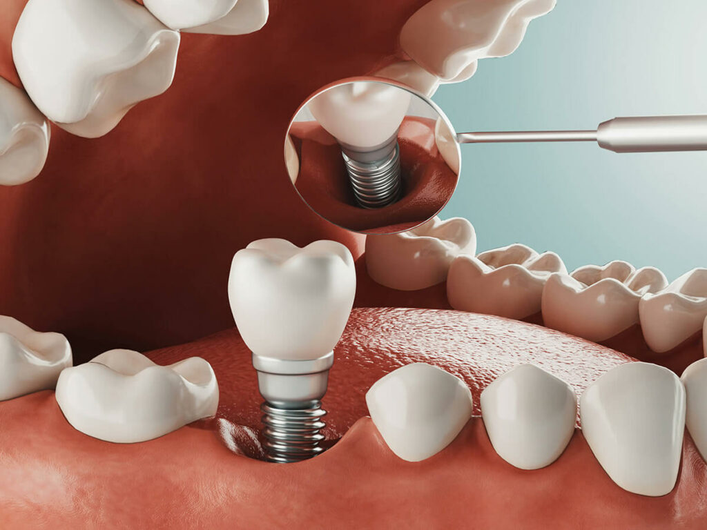 Digital rendering of a dental implant being placed into the socket