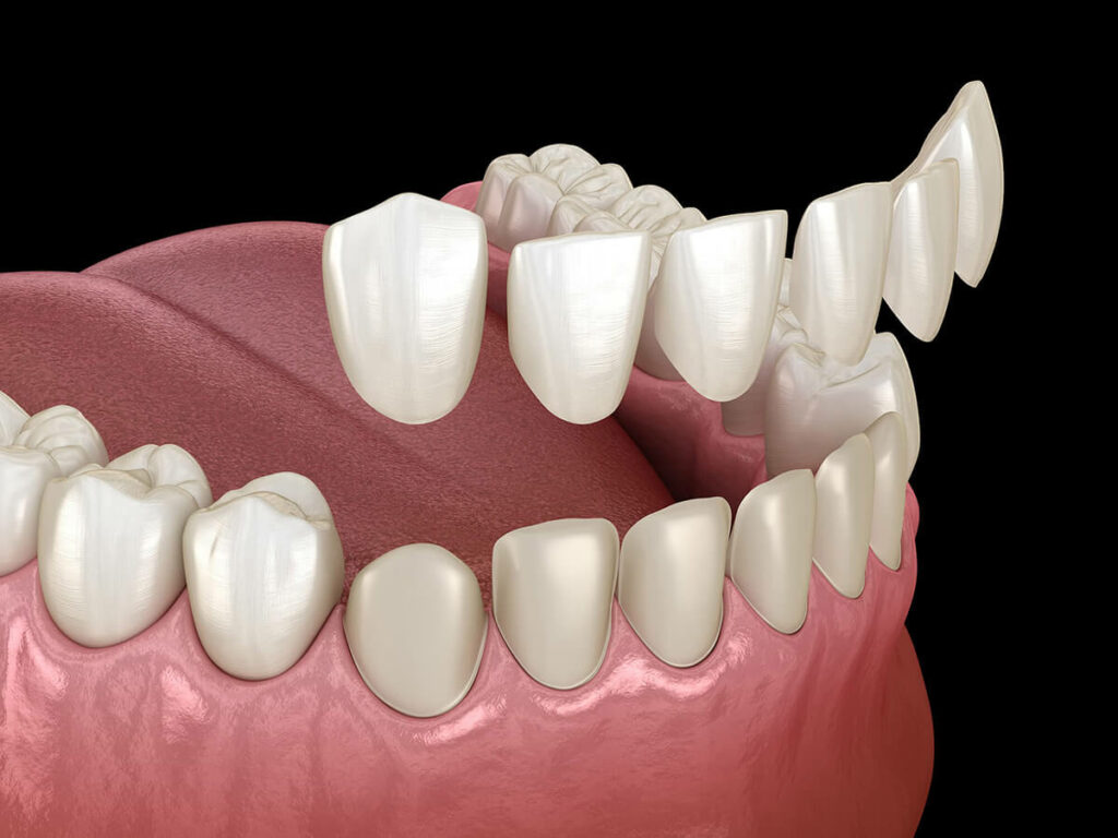 Digital rendering of the dental veneer process.