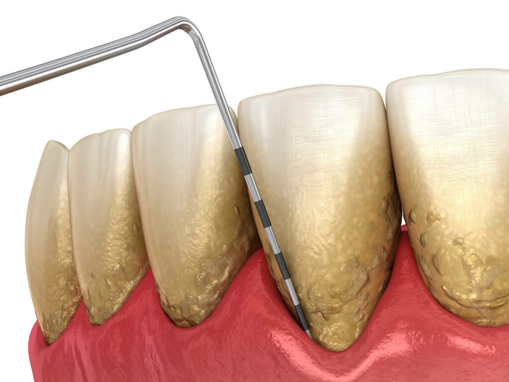 Digital rendering of teeth with periodontal disease and plaque build-up