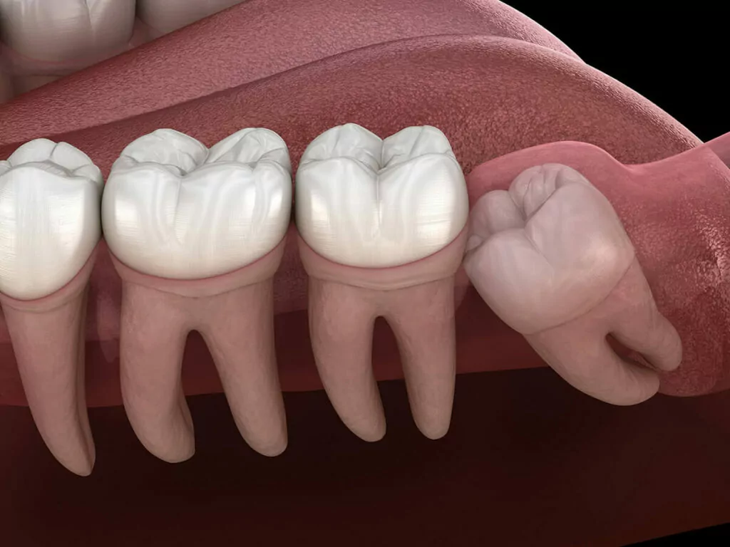 Digital rendering of an impacted wisdom tooth pushing into other teeth.