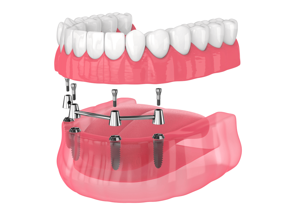 Digital rendering of all-on-4 dental implants being placed in the jaw.